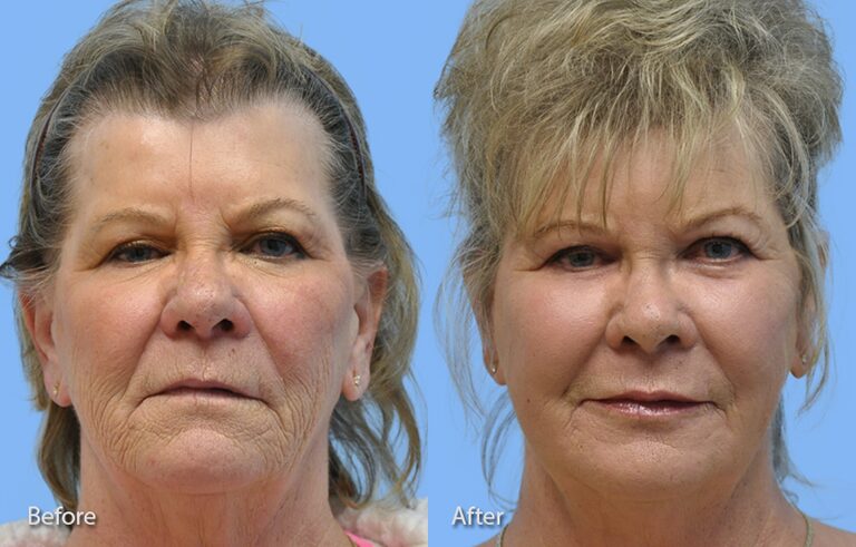 Laser Skin Resurfacing before and after photo by Midwest Facial Plastic Surgery in Minnesota
