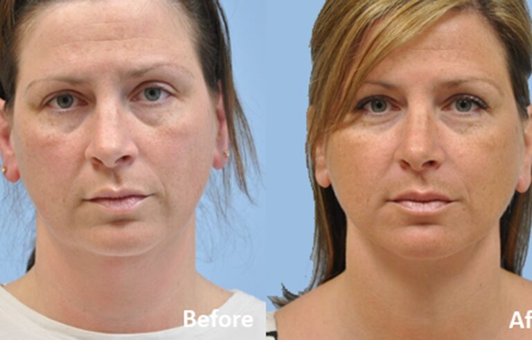 Neck Lift before and after photo by Midwest Facial Plastic Surgery in Minnesota