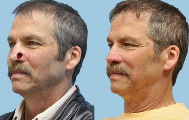 Mohs Reconstruction before and after photo by Midwest Facial Plastic Surgery in Minnesota