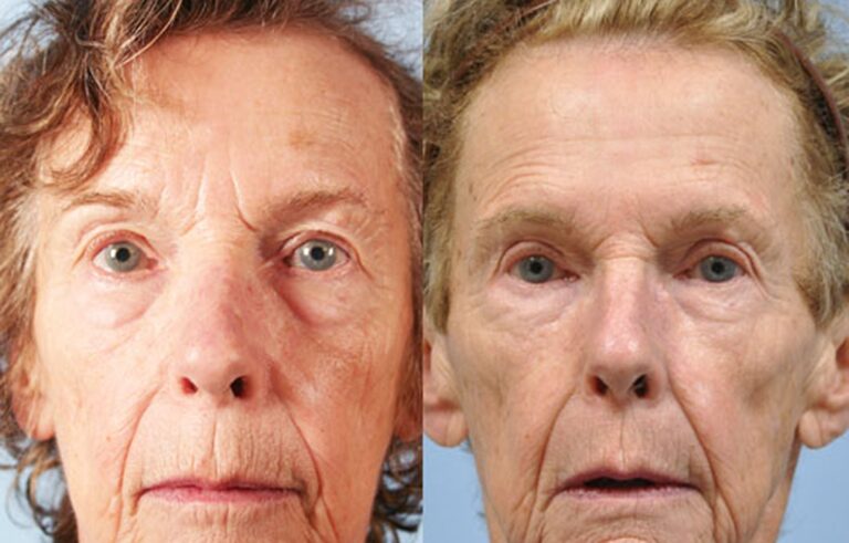 Eyelid Surgery before and after photo by Midwest Facial Plastic Surgery in Minnesota