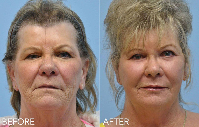 Laser Skin Resurfacing before and after photo by Midwest Facial Plastic Surgery in Minnesota
