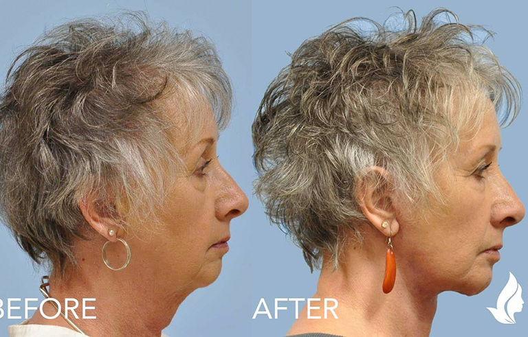 Facelift before and after photo by Midwest Facial Plastic Surgery in Minnesota