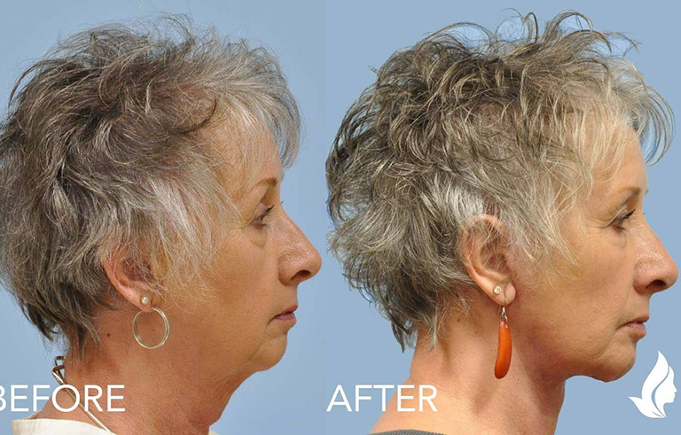 Injectable Fillers before and after photo by Midwest Facial Plastic Surgery in Minnesota