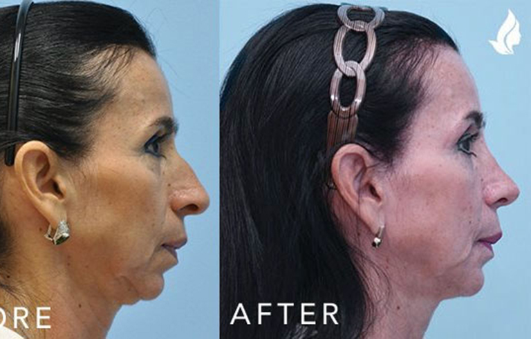 Facial Implants Chin Augmentation before and after photo by Midwest Facial Plastic Surgery in Minnesota