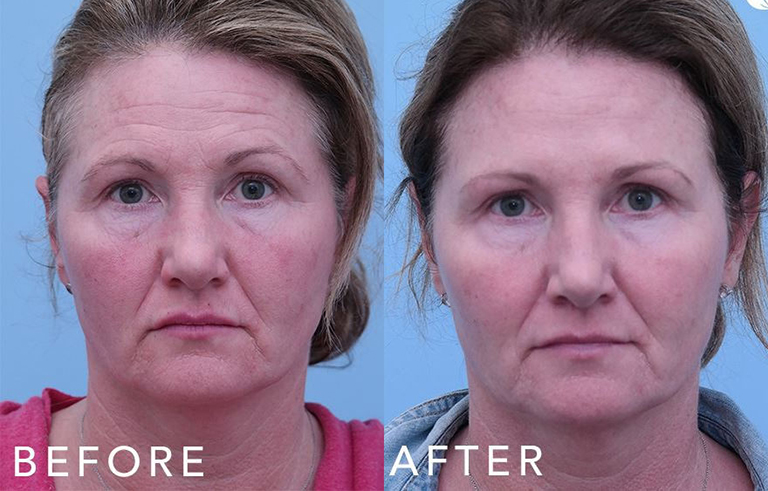 Injectable Fillers before and after photo by Midwest Facial Plastic Surgery in Minnesota