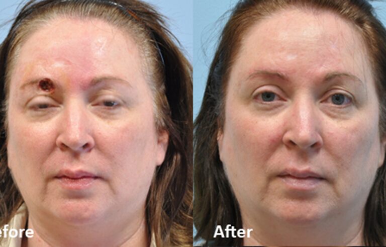 Mohs Reconstruction before and after photo by Midwest Facial Plastic Surgery in Minnesota