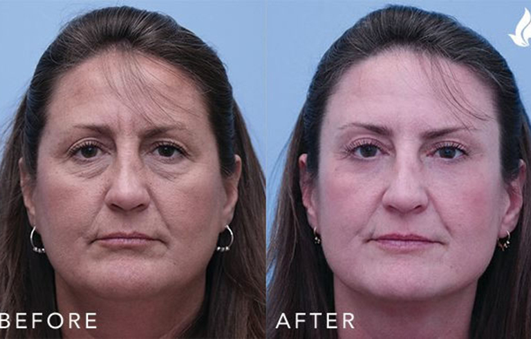 Eyelid Surgery before and after photo by Midwest Facial Plastic Surgery in Minnesota