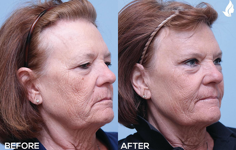 Eyelid Surgery before and after photo by Midwest Facial Plastic Surgery in Minnesota