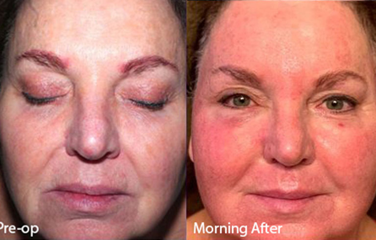 Laser Skin Resurfacing before and after photo by Midwest Facial Plastic Surgery in Minnesota