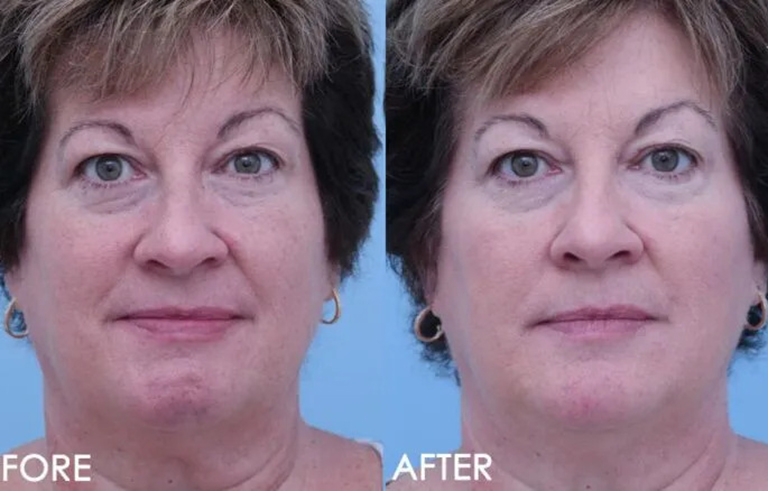 Bells Palsy before and after photo by Midwest Facial Plastic Surgery in Minnesota x