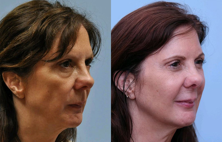 Injectable Fillers before and after photo by Midwest Facial Plastic Surgery in Minnesota
