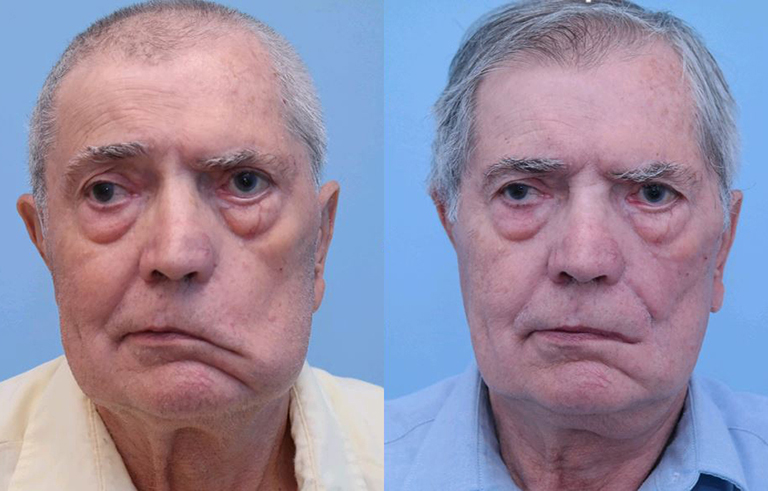Facial Paralysis before and after photo by Midwest Facial Plastic Surgery in Minnesota