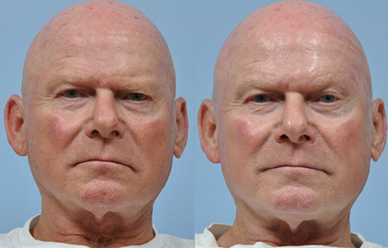 Facial Paralysis before and after photo by Midwest Facial Plastic Surgery in Minnesota