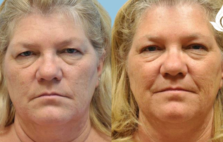 Brow Forehead Lift before and after photo by Midwest Facial Plastic Surgery in Minnesota