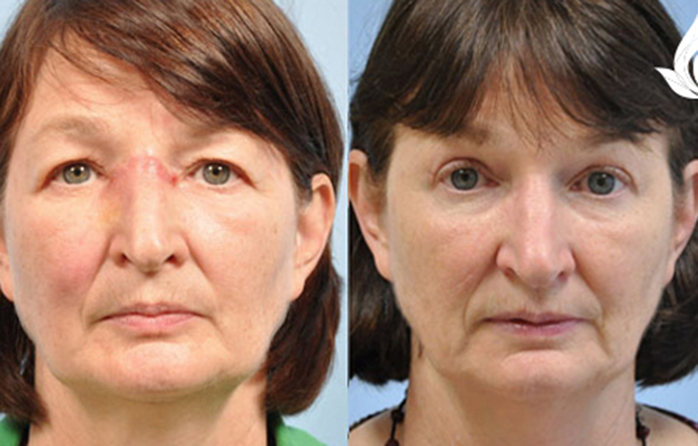 Brow Forehead Lift before and after photo by Midwest Facial Plastic Surgery in Minnesota