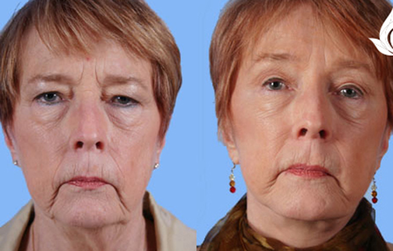 Brow Forehead Lift before and after photo by Midwest Facial Plastic Surgery in Minnesota