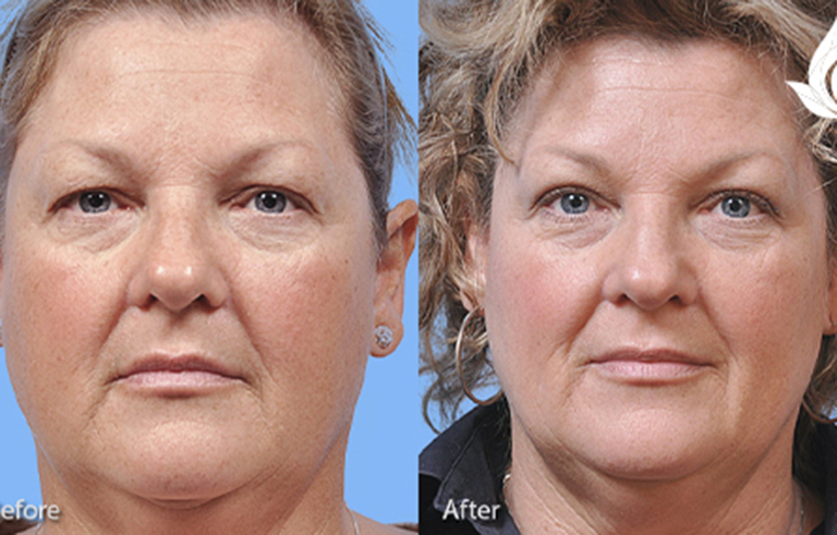 Brow Forehead Lift before and after photo by Midwest Facial Plastic Surgery in Minnesota