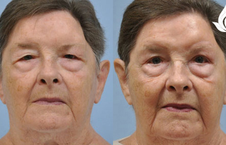 Brow Forehead Lift before and after photo by Midwest Facial Plastic Surgery in Minnesota