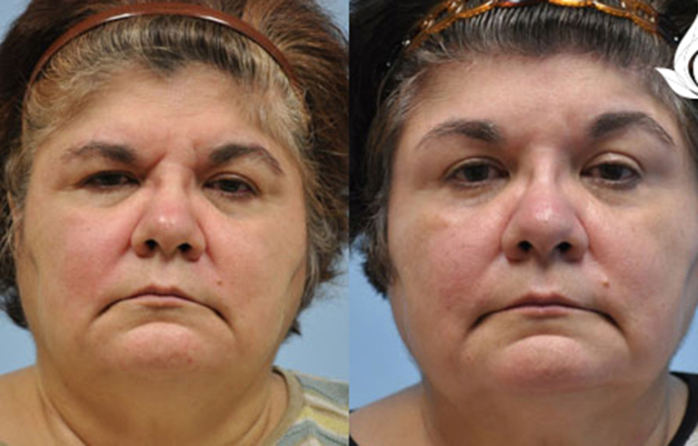 Brow Forehead Lift before and after photo by Midwest Facial Plastic Surgery in Minnesota