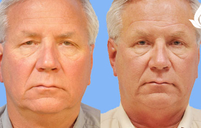 Brow Forehead Lift before and after photo by Midwest Facial Plastic Surgery in Minnesota