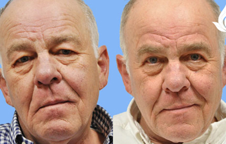 Brow Forehead Lift before and after photo by Midwest Facial Plastic Surgery in Minnesota