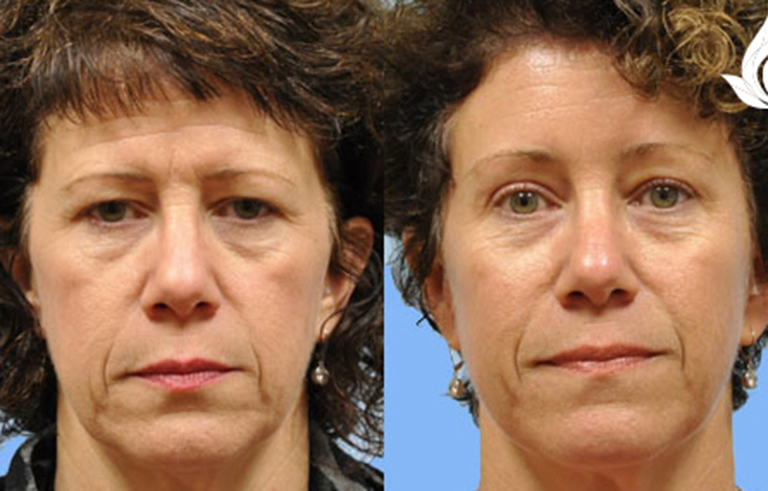 Brow Forehead Lift before and after photo by Midwest Facial Plastic Surgery in Minnesota