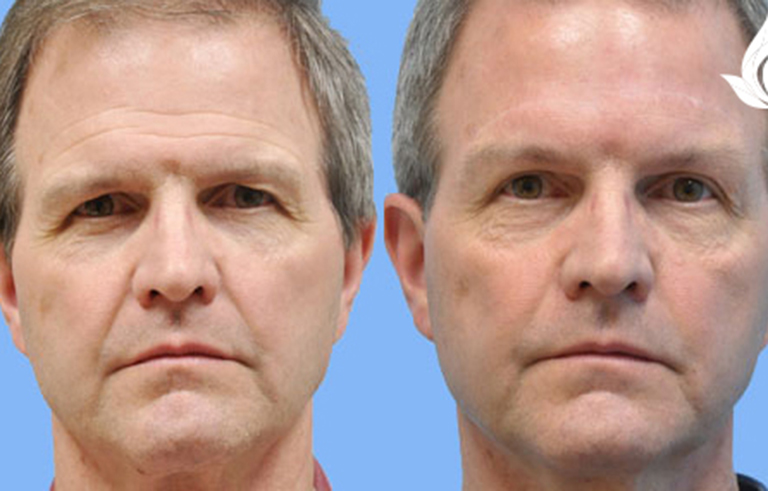 Brow Forehead Lift before and after photo by Midwest Facial Plastic Surgery in Minnesota