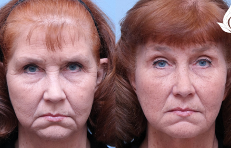 Brow Forehead Lift before and after photo by Midwest Facial Plastic Surgery in Minnesota
