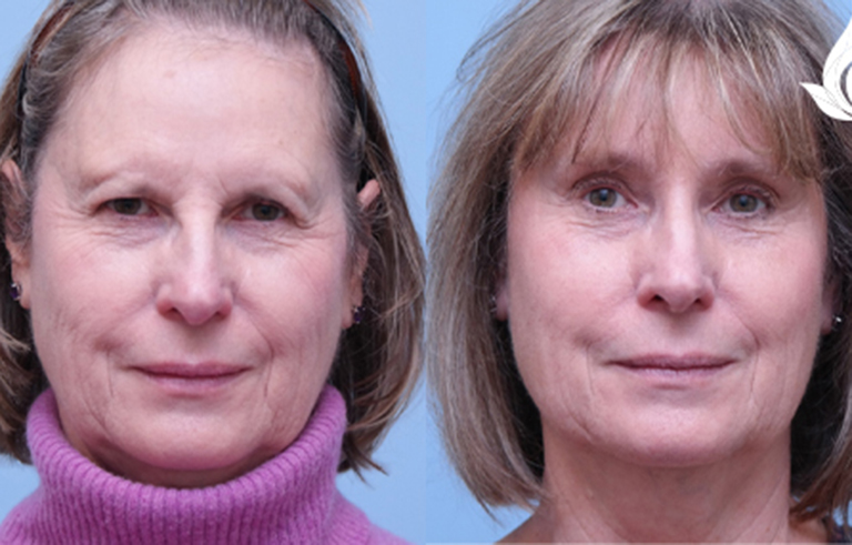 Brow Forehead Lift before and after photo by Midwest Facial Plastic Surgery in Minnesota