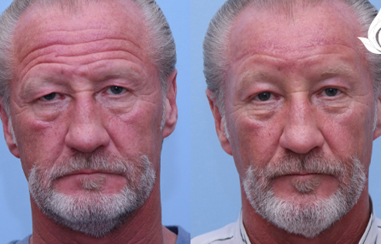 Brow Forehead Lift before and after photo by Midwest Facial Plastic Surgery in Minnesota