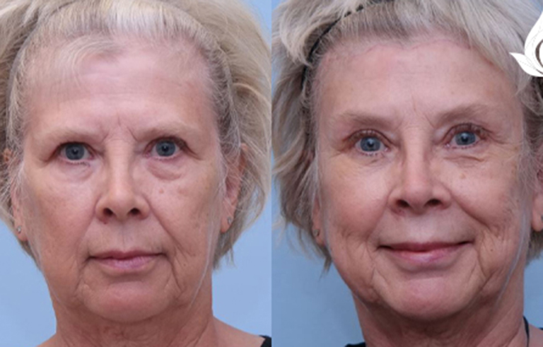 Brow Forehead Lift before and after photo by Midwest Facial Plastic Surgery in Minnesota