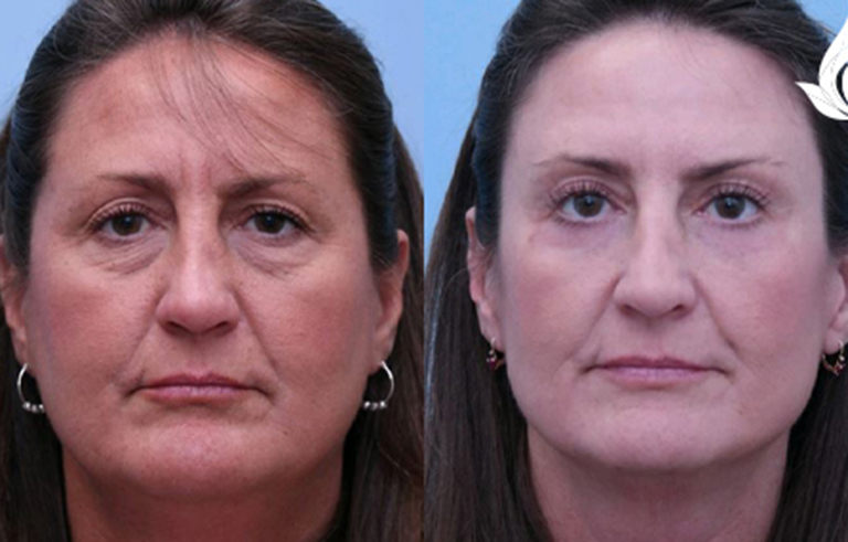 Brow Forehead Lift before and after photo by Midwest Facial Plastic Surgery in Minnesota