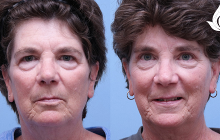 Brow Forehead Lift before and after photo by Midwest Facial Plastic Surgery in Minnesota