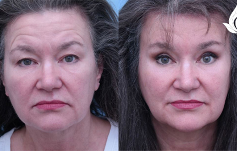 Brow Forehead Lift before and after photo by Midwest Facial Plastic Surgery in Minnesota