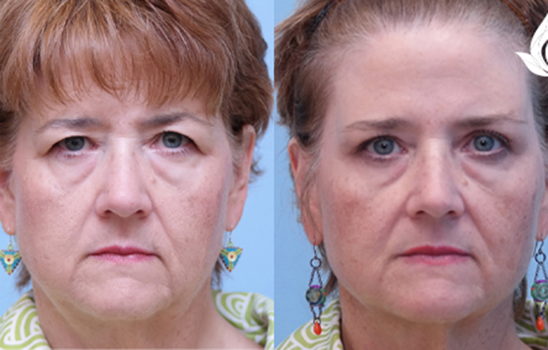 Brow Forehead Lift before and after photo by Midwest Facial Plastic Surgery in Minnesota