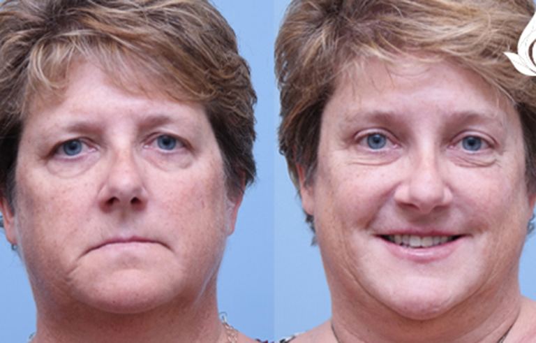 Brow Forehead Lift before and after photo by Midwest Facial Plastic Surgery in Minnesota