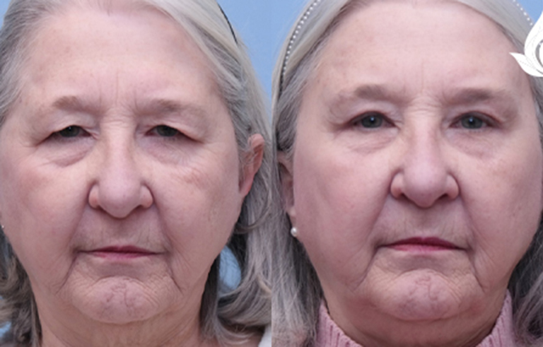 Brow Forehead Lift before and after photo by Midwest Facial Plastic Surgery in Minnesota