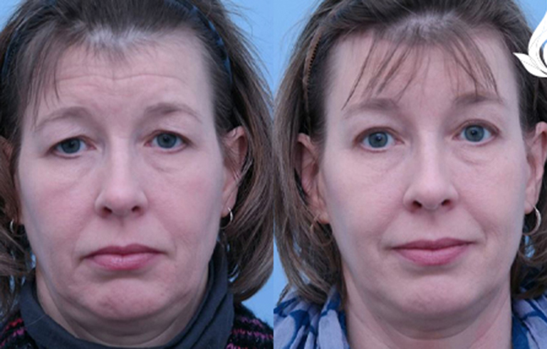 Brow Forehead Lift before and after photo by Midwest Facial Plastic Surgery in Minnesota