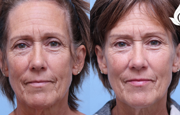 Brow Forehead Lift before and after photo by Midwest Facial Plastic Surgery in Minnesota