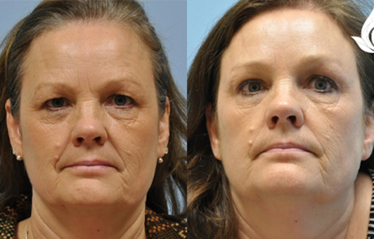 Brow Forehead Lift before and after photo by Midwest Facial Plastic Surgery in Minnesota