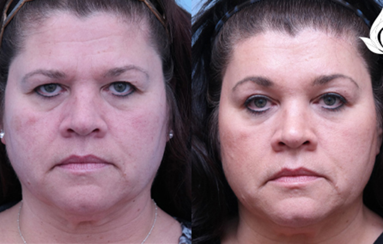 Brow Forehead Lift before and after photo by Midwest Facial Plastic Surgery in Minnesota