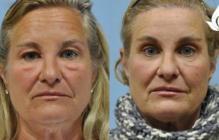 Brow Forehead Lift before and after photo by Midwest Facial Plastic Surgery in Minnesota