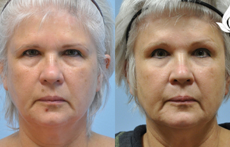Brow Forehead Lift before and after photo by Midwest Facial Plastic Surgery in Minnesota