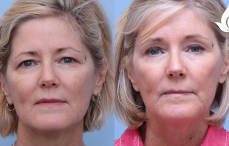 Brow Forehead Lift before and after photo by Midwest Facial Plastic Surgery in Minnesota