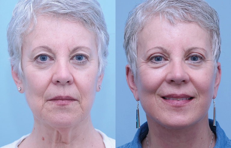 Facelift before and after photo by Midwest Facial Plastic Surgery in Minnesota