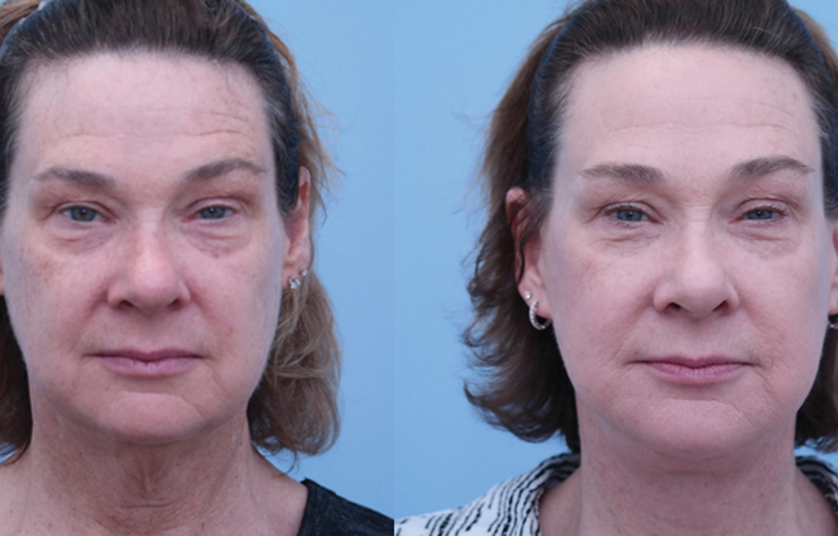 Facelift before and after photo by Midwest Facial Plastic Surgery in Minnesota