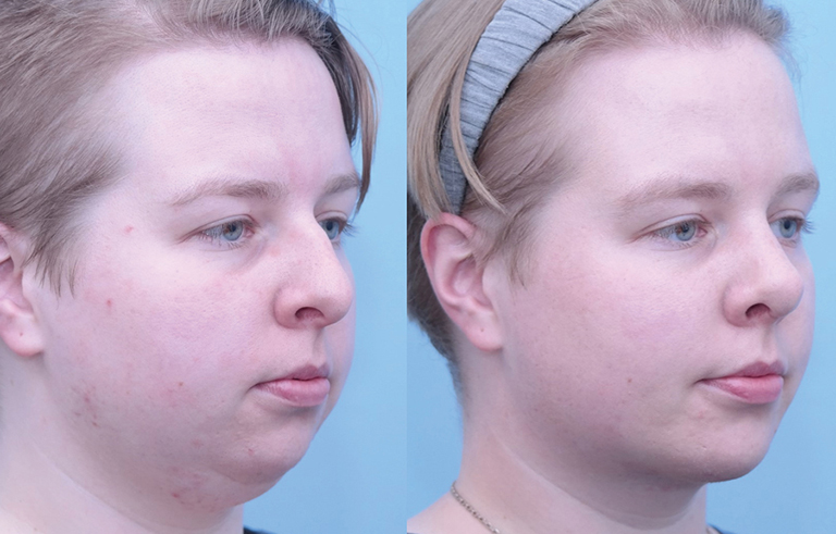 Facial Implants Chin Augmentation before and after photo by Midwest Facial Plastic Surgery in Minnesota
