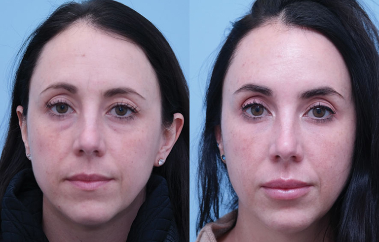 Injectable Fillers before and after photo by Midwest Facial Plastic Surgery in Minnesota
