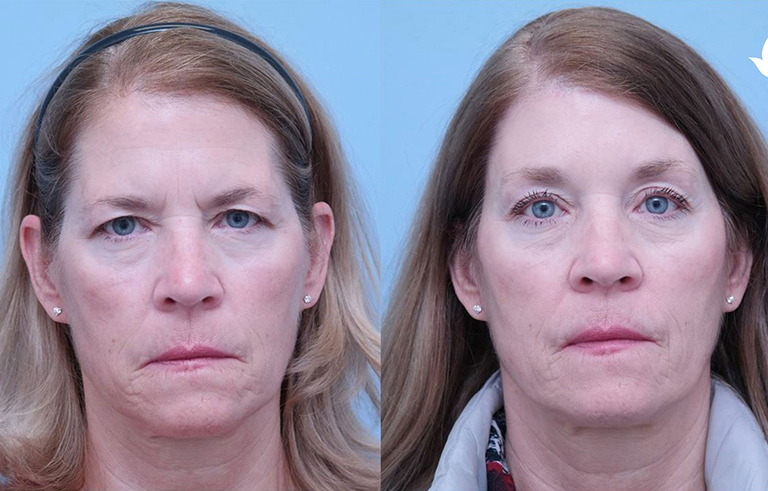 Brow Forehead Lift before and after photo by Midwest Facial Plastic Surgery in Minnesota