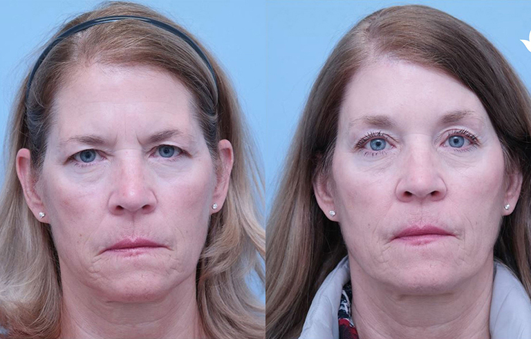 Eyelid Surgery before and after photo by Midwest Facial Plastic Surgery in Minnesota